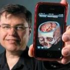 Aplicativo para iPhone permite diagnóstico de derrame cerebral