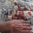 Bebê nasce prematuro com 450 gramas e sobrevive