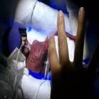 Bebê sobrevive nos Estados Unidos após nascer com apenas 270 gramas