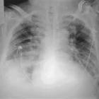 Pneumonia aspirativa do idoso