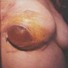 Doenças crônicas causadas por próteses mamárias de silicone e salinas.