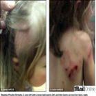 Menina de 3 anos tem os cabelos arrancados em ataque de cachorro