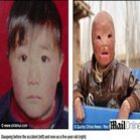 Chinês de 5 anos ganha cirurgia para reconstruir o rosto queimado