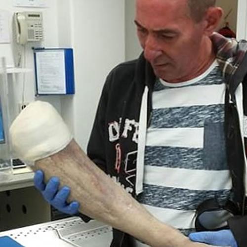 Homem tenta vender perna amputada no eBay
