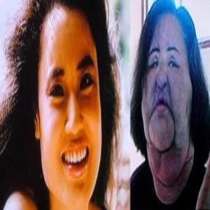 Coreana injetou óleo de cozinha no rosto: olha o resultado....