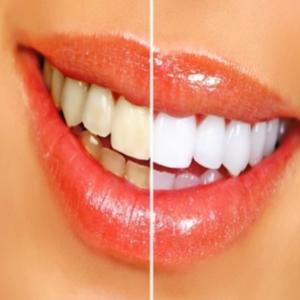 Dente amarelado: causas e tratamento para clarear seu sorriso amarelo