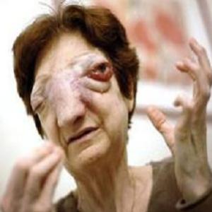 Doença dos olhos que pode causar cegueira