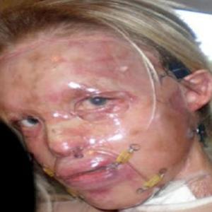 Mulher se recupera após ter rosto deformado por ácido