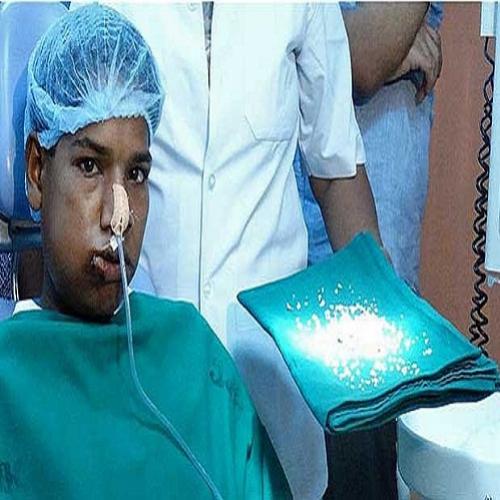 Médicos da Índia removem 232 dentes da boca de menino