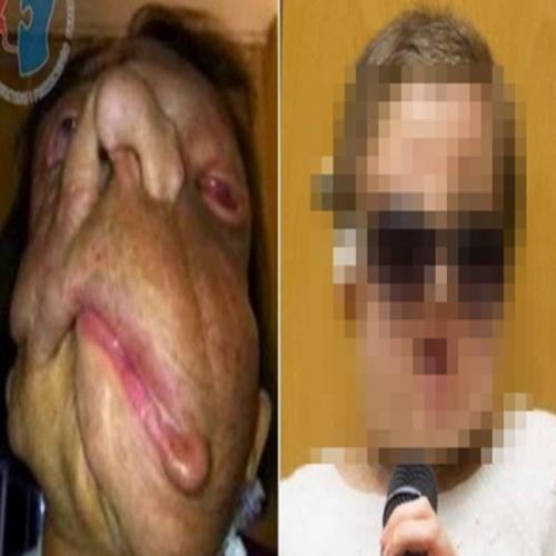 Jovem que recebeu transplante facial completo mostra resultado