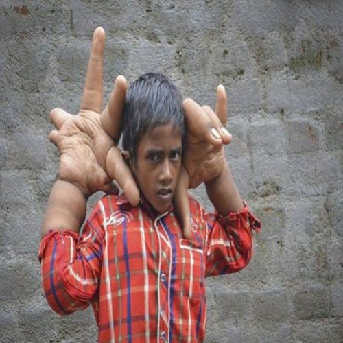 Garoto indiano tem mãos gigantes
