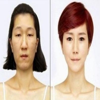 Coreana fica totalmente diferente após cirurgias no rosto