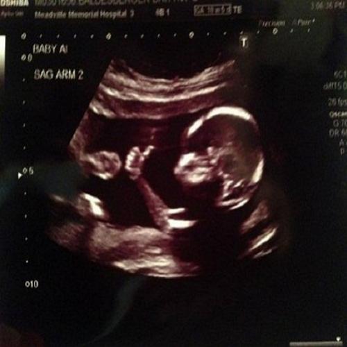 Bebê aparece fazendo sinal de joinha no ultrassom