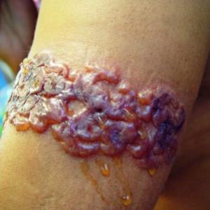 Perigos em tatuagens de henna