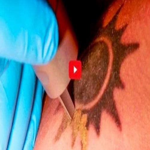 Vídeo mostra como se remove tatuagem a laser