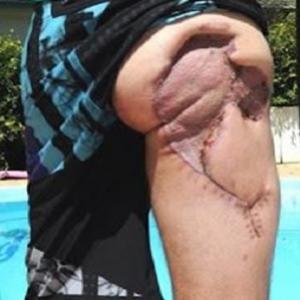 Surfista mostra o estrago na perna após mordida de tubarão