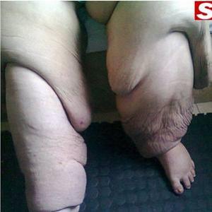 Com problemas linfáticos, pernas de sul-africana pesam 128kg 