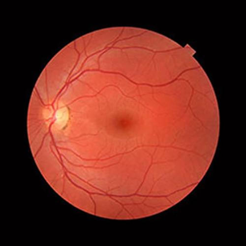 Terapia gênica restaura visão de portadores de cegueira