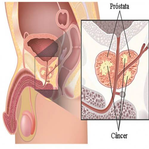 O que é câncer de próstata?