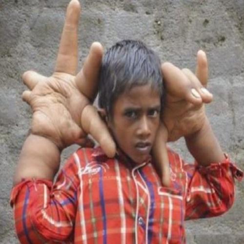 Menino indiano tem mãos gigantes de 33 centímetros e 13 quilos. (vídeo
