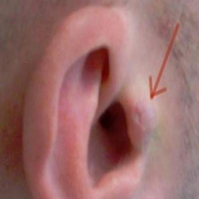 Loucura! Homem implanta headphone na orelha