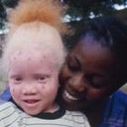 Projeto de lei quer obrigar governo a fornecer protetor solar aos albinos
