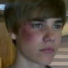 Justin Bieber aparece com olho roxo