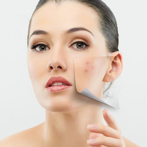 Saiba como combater à acne na pele adulta!