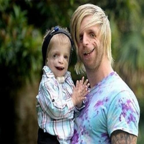 Homem com doença rara viaja para conhecer criança com a mesma síndrome