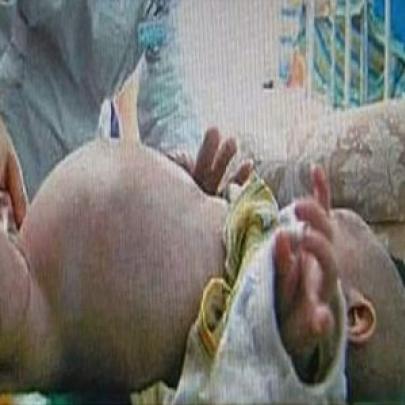 Bizarro! Menino de dois anos grávido passa por cirurgia