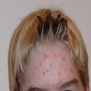 10 Mitos sobre a acne