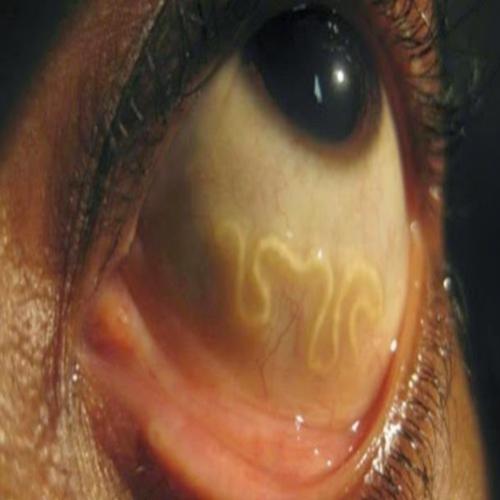 Veja verme de 19 cm ser removido de um olho humano (vídeo)