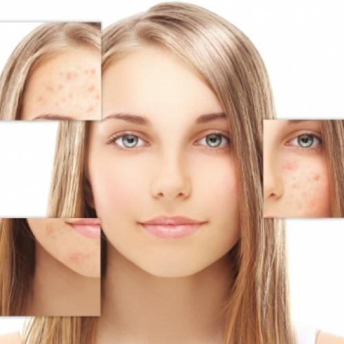 Entenda a causa da acne em cada área do rosto