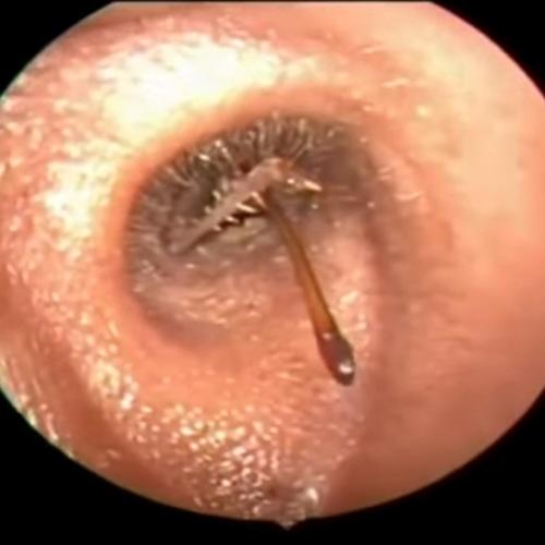 Médicos tiram inseto gigante do ouvido de homem