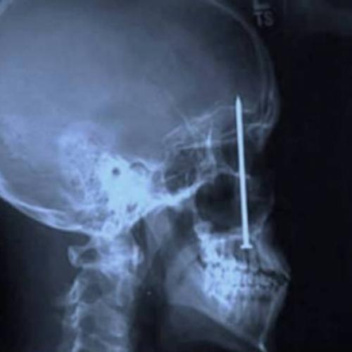 14 Coisas estranhas encontradas em exames de raio-x