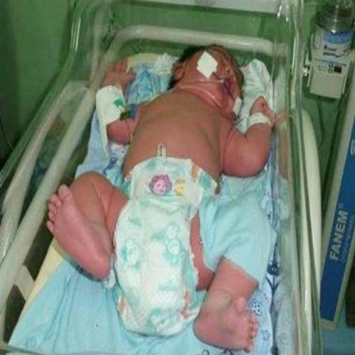 Impressionante: Bebê prematuro nasce com 6,7 kg em maternidade