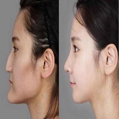 19 cirurgias plásticas que mudaram o rosto destas pessoas 