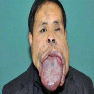 Chinês de língua gigante de 25 cm não abre a boca há 21 anos