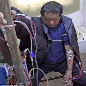 Chinês sobrevive 13 anos fazendo diálise com máquina caseira