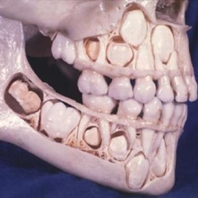 Onde estão os dentes permanentes, enquanto temos os dentes de leite