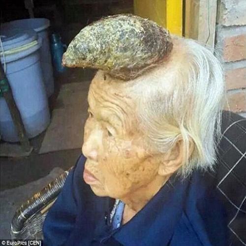 Idosa de 87 anos tem chifre de quase 13 cm crescendo em sua cabeça
