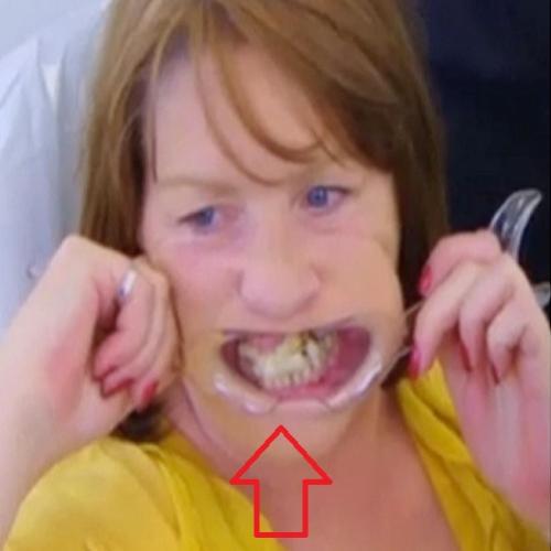 Mulher usa super cola para colocar de volta na boca dentes que caíram