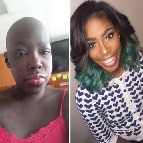 Antes e depois de passarem pelo câncer