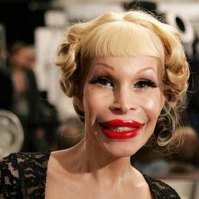 10 pessoas que não souberam usar Botox da maneira certa