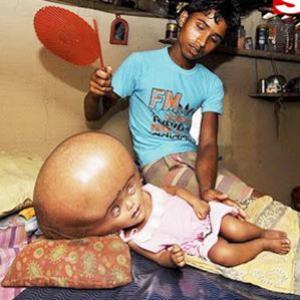 Bebê indiana com hidrocefalia grave receberá tratamento médico gratuit