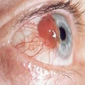 Paraneoplasia de olho: Que patologia é essa?