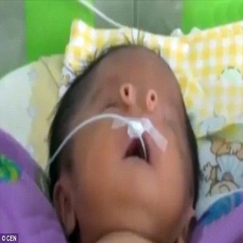 Bebê nascer com 2 tubos no rosto no lugar de um nariz